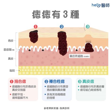 黑痔|為什麼臉上的痣越來越多？皮膚科醫師解析長痣原因、。